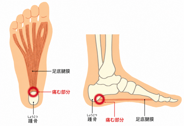 足底腱膜炎（足底筋膜炎）